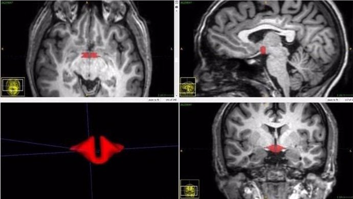 Resonancia magnética cerebral que muestra el hipotálamo en rojo.