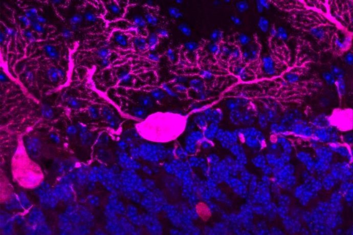 Cuando el sistema que transporta las moléculas a través de las largas ramas de las neuronas (rosadas) se descompone, el caos se produce lentamente.