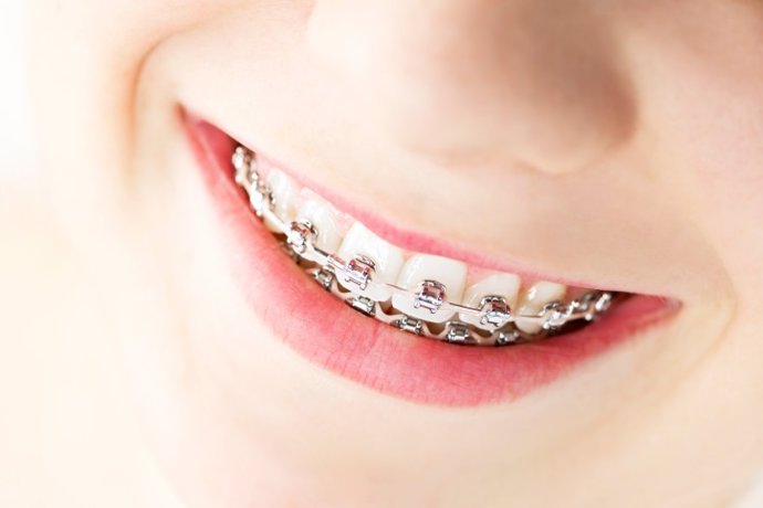 Smile with braces