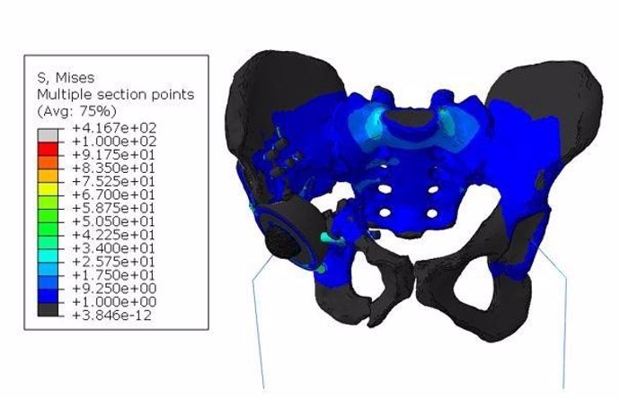 Distribución general de tensiones en el modelo "endoprótesis-esqueleto" de la estructura biomecánica cuando el paciente está de pie sobre dos piernas.