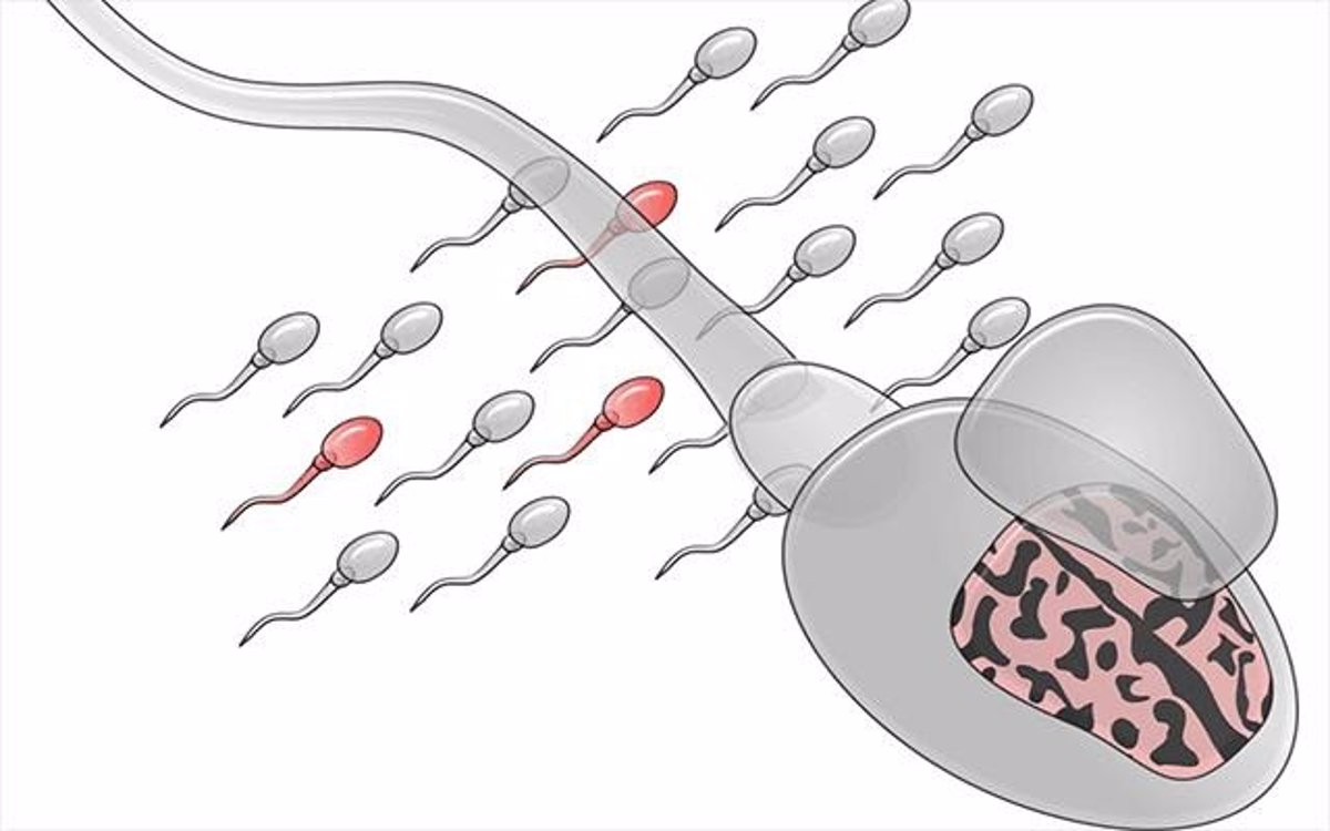 Mutaciones espontáneas en los espermatozoides paternos, relacionadas con el  autismo