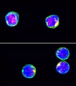 La  imagen de inmunofluorescencia muestra CD3 (verde), Tet2 (rojo) y DAPI (azul) en células T CD4 + humanas de la sangre periférica de individuos con diabetes tipo 1 recientemente diagnosticada (abajo) e individuos sin diabetes tipo 1 (arriba).