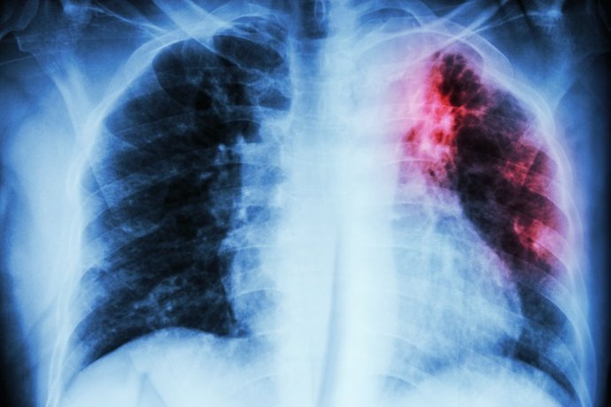 Fibrosis pulmonar, pulmones.