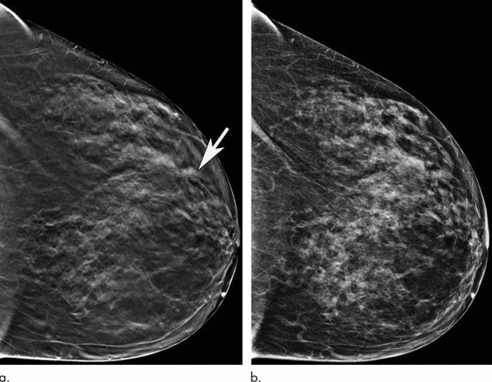 Las mujeres mayores se benefician significativamente cuando se las examina con una mamografía 3-D