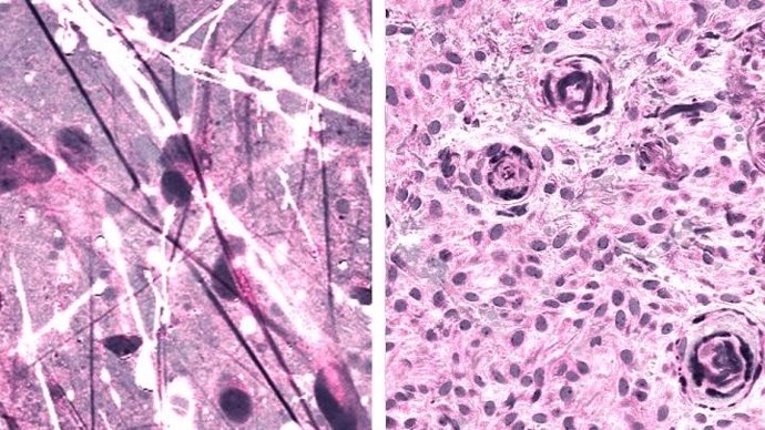 Imágenes histológicas Raman estimuladas de astrocitoma difuso (izquierda) y meningioma (derecha).