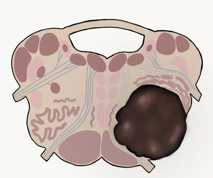 Gliomas de alto grado en el tronco cerebral