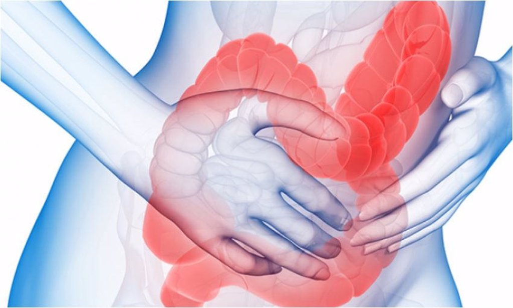 El tratamiento para la colitis ulcerosa no reduce el riesgo de cáncer