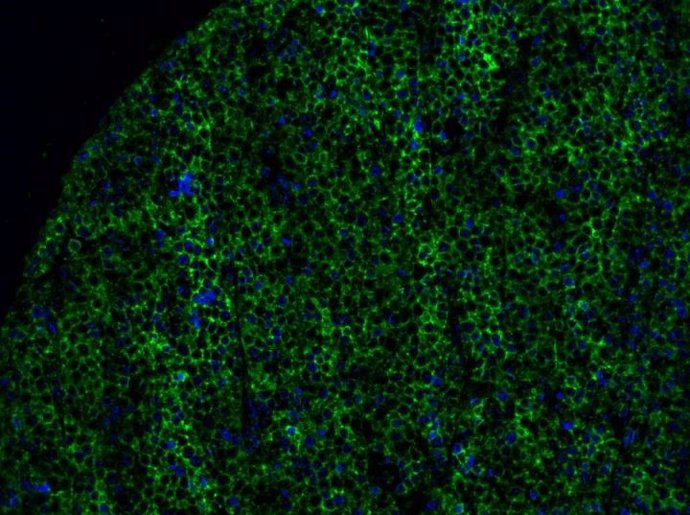 La imagen muestra parte de un tumor de melanoma con expresión de butirofilina 2A1 resaltada en verde y núcleos celulares en azul.