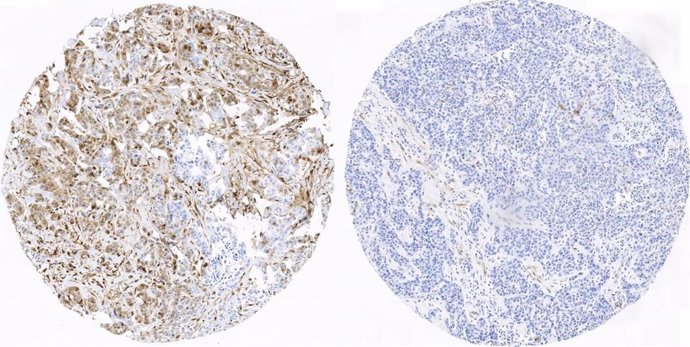    Investigadores del Centro Nacional de Investigaciones Oncológicas (CNIO) han identificado seis proteínas quinasas cuyo estado funcional predice la evolución del cáncer de mama triple negativo, el tumor más agresivo y más difícil de tratar, aunque el 