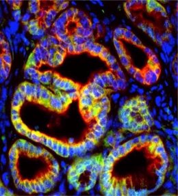 Las células tumorales pancreáticas de ratón (rojo) producen la proteína de señalización IL-1 (verde) para apoyar el crecimiento del cáncer al suprimir el sistema inmune.