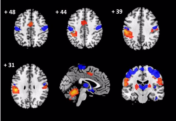 Daños a nivel cerebral en pacientes con compresión prolongada de la médula