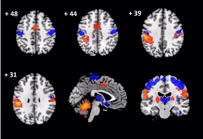 Investigadores españoles demuestran que las hernias cervicales generan una serie