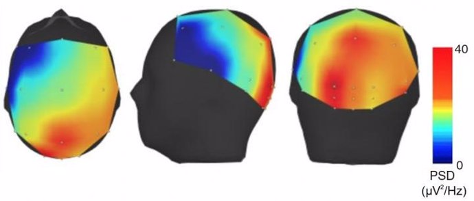 Mapa de intensidad del EEG en pacientes con temblor esencial. La intensidad más alta (rojo) se localiza en la región cerebelosa del cerebro.