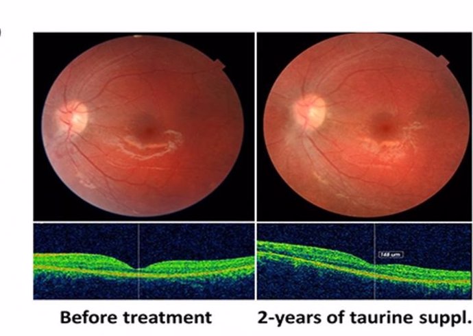 Fotografías del fondo de ojo izquierdo del paciente en la línea de base y después de 24 meses de suplementación de taurina, mostrando la estabilidad anatómica con la preservación de los fotorreceptores.