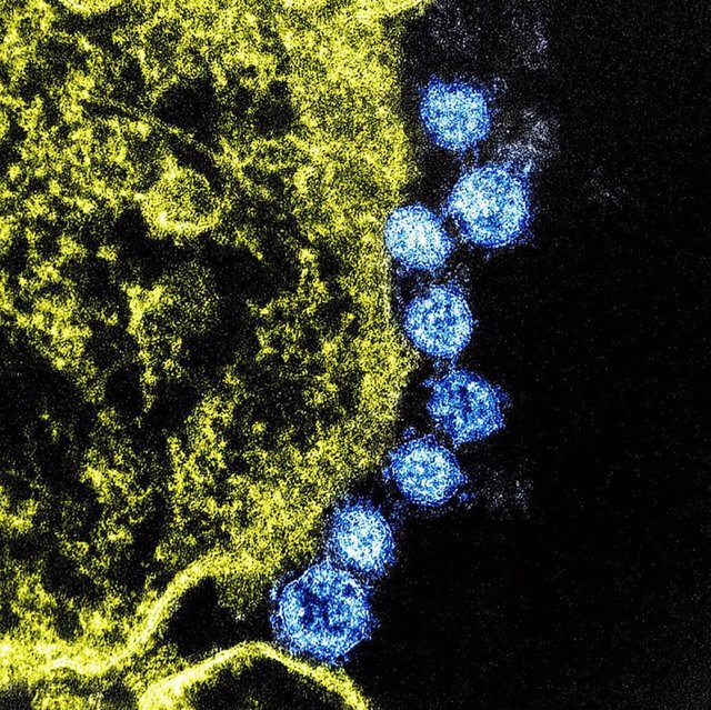 Partículas del virus MERS (azul) que se encuentran cerca de la periferia de una célula VERO E6 infectada (amarillo).