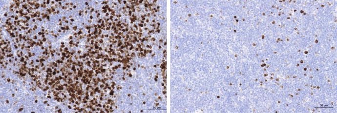 A la izquierda, linfoma folicular en ratón con abundantes células B en multiplicación teñidas en marrón. A la derecha, inhibición de esta multiplicación por el tratamiento con rapamicina.