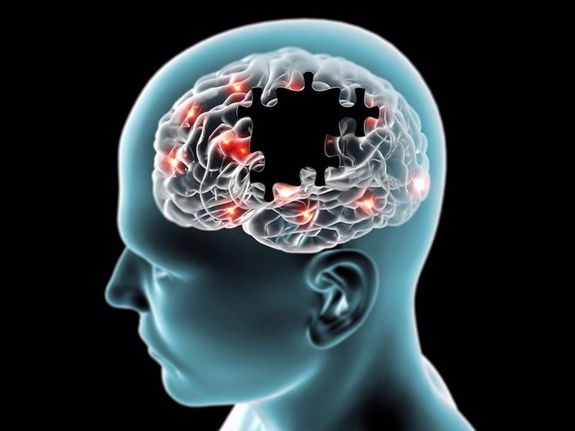 Cerebro en la enfermedad de Parkinson