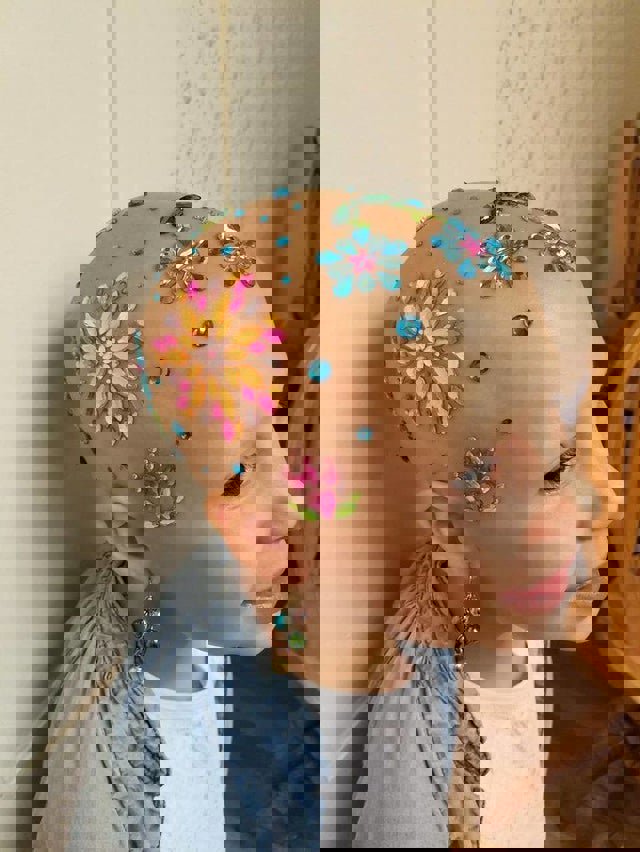 Reddit - niña alopecia