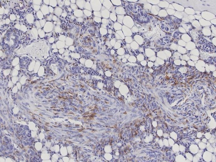 Los macrófagos (marrón), los carroñeros del sistema inmune, migran al tejido enfermo (células cancerosas: azul) sin destruirlo.