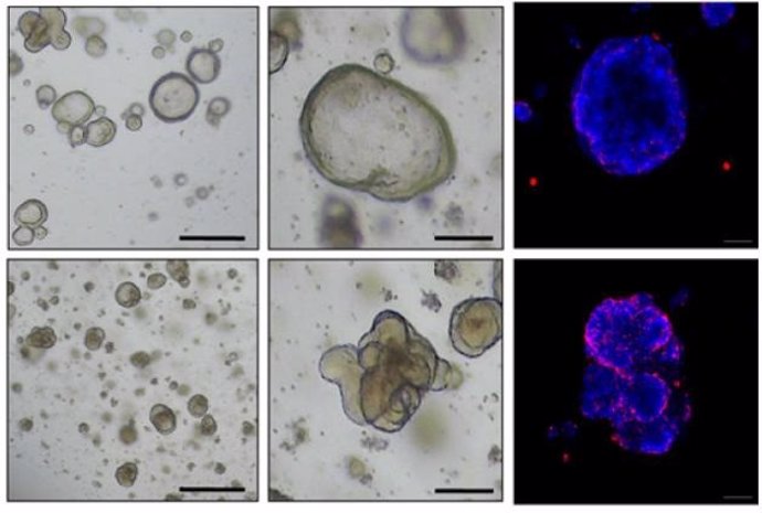 Expresión de SETDB1 en tejidos de cáncer colorrectal y diferenciación celular de los organoides de cáncer de colon derivados de pacientes al agotarse el SETDB1.