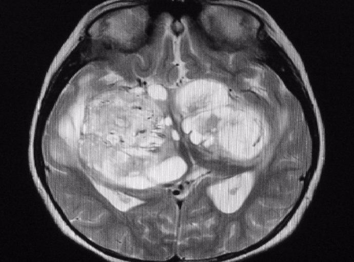 Glioma.