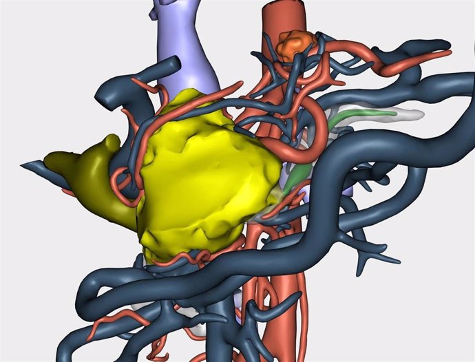 Reconstrucción 3D de un tumor para abordar su resección en una cirugía a paciente oncológico
