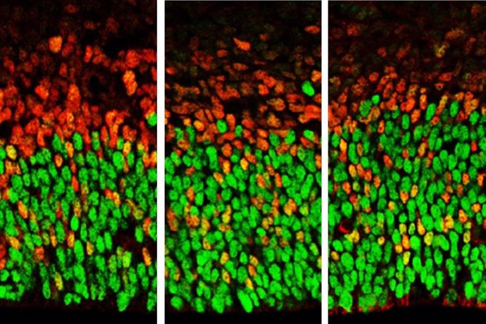 La imagen muestra células cerebrales con niveles bajos de función Foxp1 (a la izquierda) y niveles altos (a la derecha). La glía apical radial está teñida de verde y los progenitores secundarios y las neuronas están teñidas de rojo.
