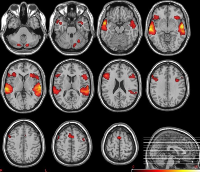 Proyecto impulsado por el Instituto de Investigación Sanitaria INCLIVA, y (UPV que permite mejorar los sistemas de diagnóstico y tratamiento en psicosis