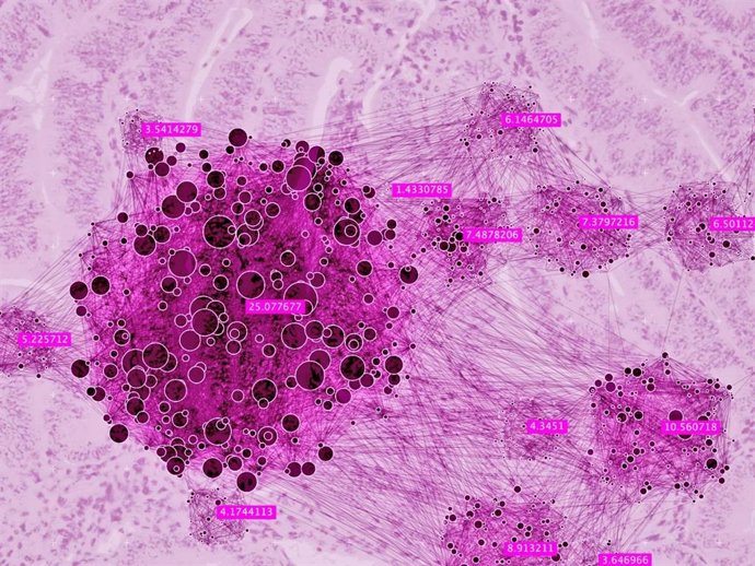 Ilustración de cáncer de endometrio.