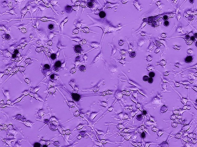 Células de glioblastoma de un cerebro humano están creciendo. La adición del virus oncolítico Ebola-VSV produce infección tumoral y muerte celular, vista aquí como células negras. Con el tiempo, la infección se propaga a otras células de glioblastoma.