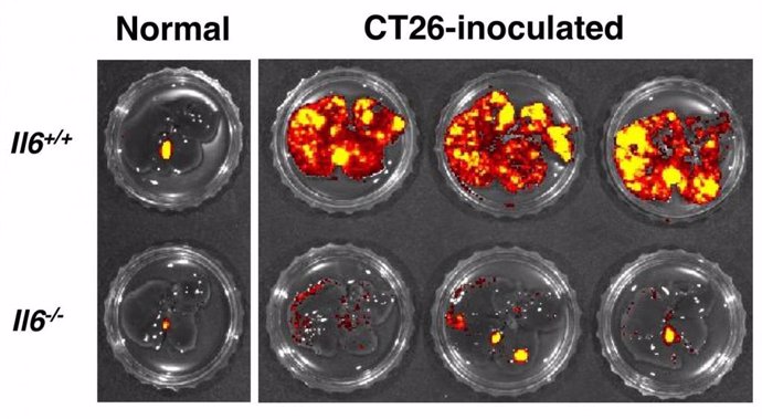 Células de cáncer colorrectal se reducen cuando se desactiva la proteína IL-6