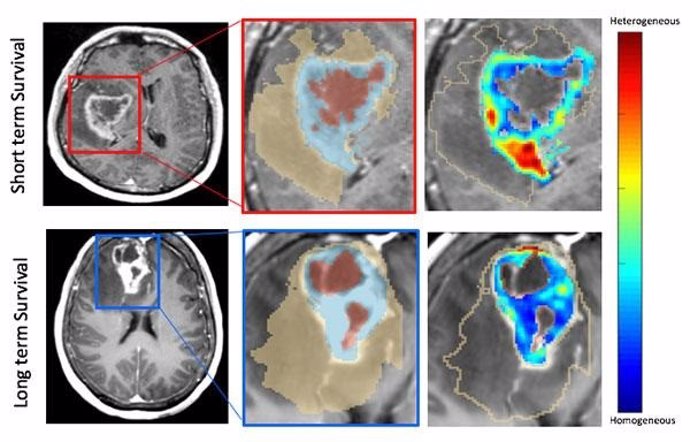 Un ejemplo de las resonancias magnéticas que muestran indicaciones de supervivencia a largo y corto plazo de pacientes con neuroblastoma.