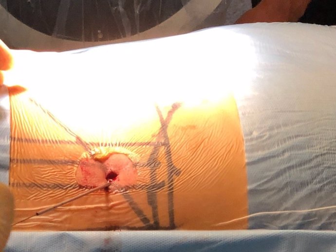 Quirónsalud Marbella realiza una innovadora cirugía para lesiones de columna