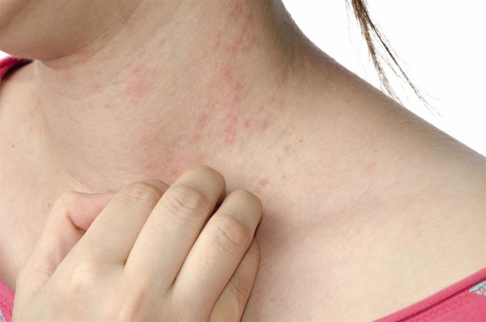 Eczema, eccema, urticaria, alergia en la piel