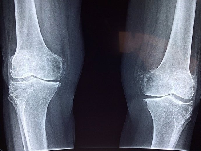 Radiografía de rodilla.