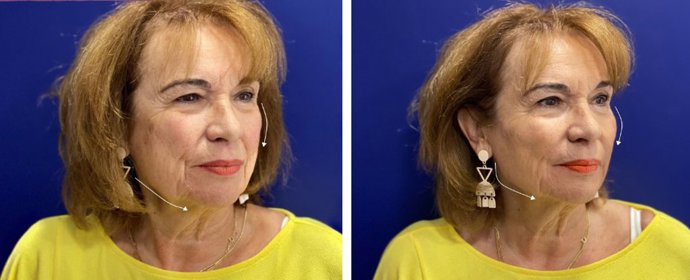 Revertimiento facial