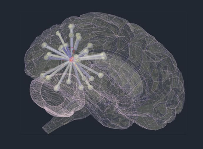 Propagación de la proteína tau en el cerebro de un paciente con Alzheimer