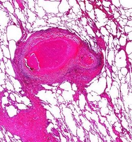 Imagen de tejido pulmonar de un enfermo de tuberculosis