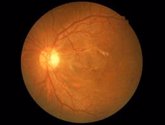 Foto: Un panel de biomarcadores ayuda a predecir el desarrollo del glaucoma en un 80% de los casos estudiados