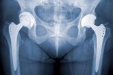 Foto: Por qué fallan las prótesis de cadera: Aflojamientos e infecciones