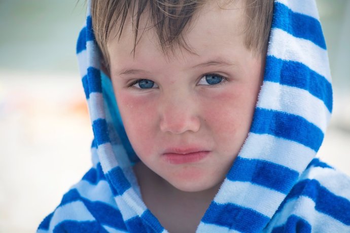 Little boy with atopic dermatitis in a striped bathrobe