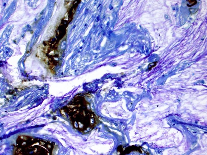 Las áreas marrones se tiñen para un biomarcador en el tejido de un paciente que desarrolló cáncer de páncreas a partir de un quiste.