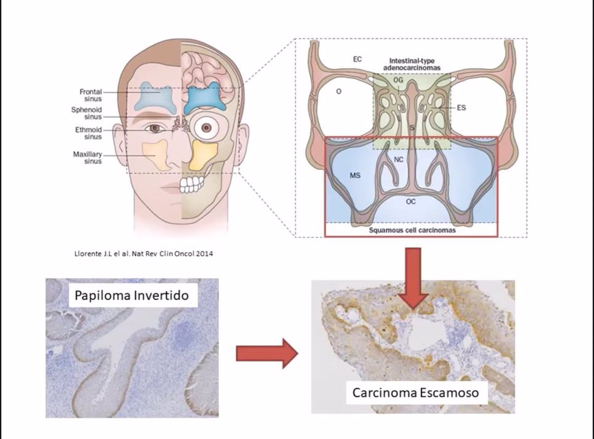 Papiloma inverso nasal, Complicații de enterobioză Papiloma inverso nasal