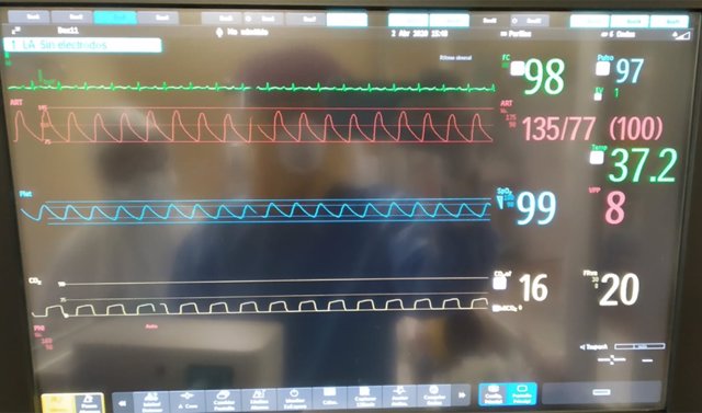 El respirador 'Andalucía Respira' supera con éxito el segundo ensayo en humanos