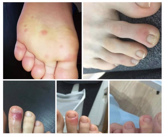 Sintomas del Covid-19 en los pies de los niños