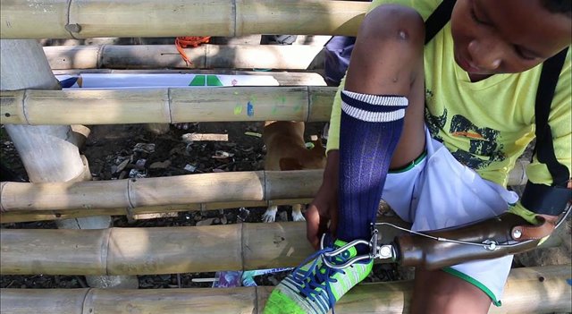 Gemerson fue víctima de un resto explosivo de guerra y perdió una se sus manos cuando tenía 11 años