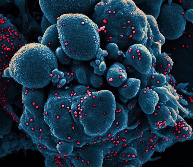 Micrografía electrónica de barrido coloreada de una célula apoptótica, en azul, infectada con partículas del virus SARS-COV-2, en color rojo, aislada de una muestra de paciente.