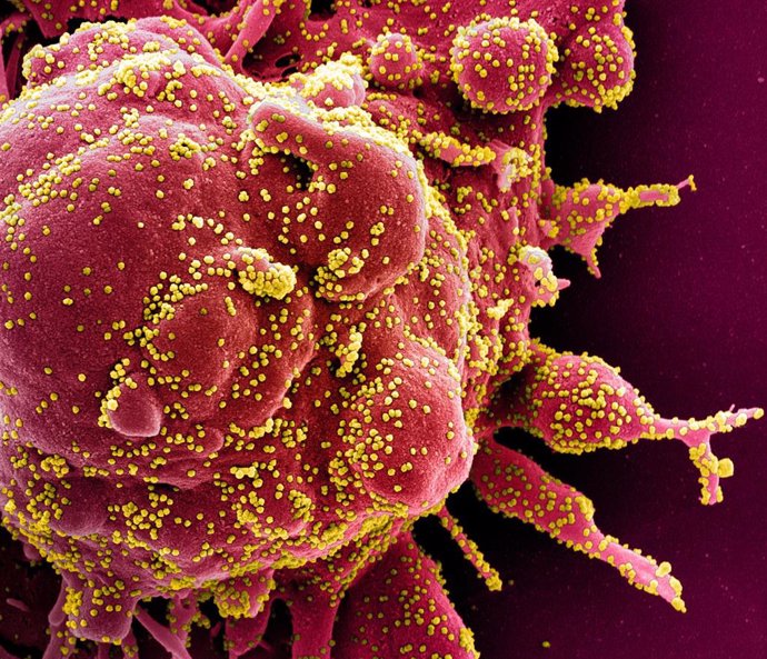 Micrografía electrónica de barrido coloreada de una célula apoptótica, en rojo, infectada con partículas del virus SARS-COV-2, en color amarillo, aislada de una muestra de paciente.