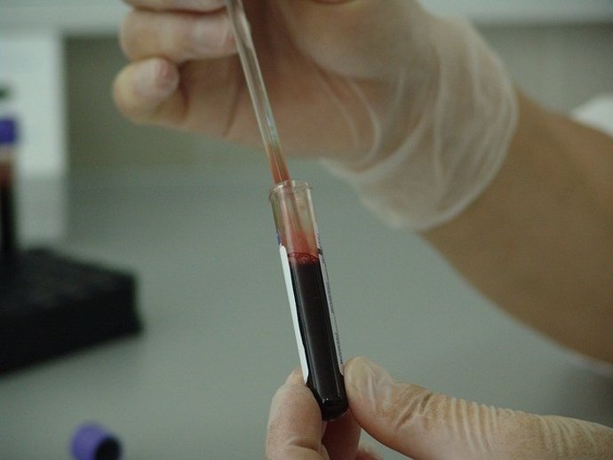 La biopsia líquida puede ayudar a los médicos a detectar el cáncer de páncreas e