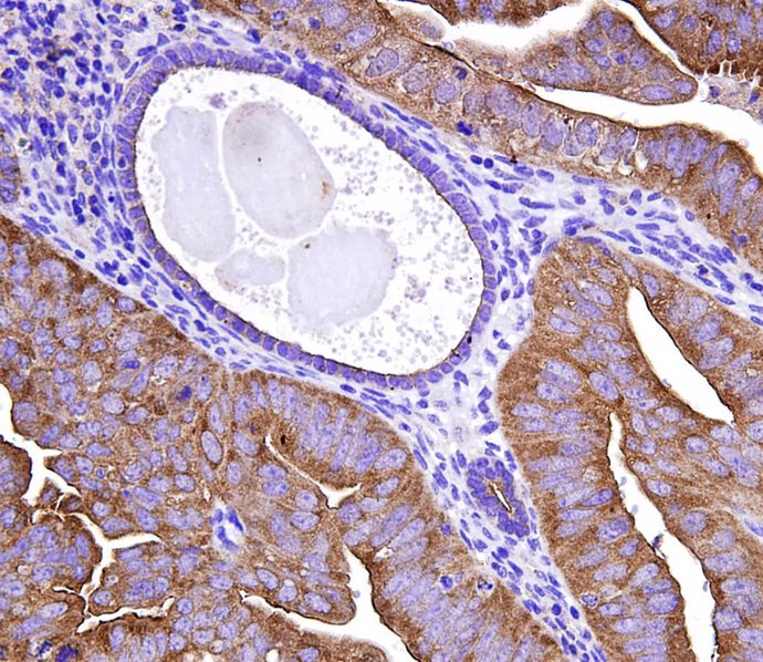 Nuevos marcadores moleculares para el diagnóstico de cáncer de endometrio para discriminar muestras tumorales y normales 
